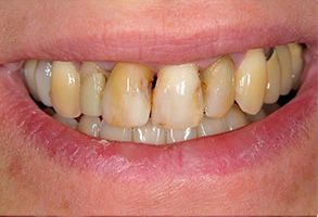 Verrett Dental Center | Veneers, Periodontal Treatment and Teeth Whitening