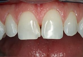 Verrett Dental Center | Digital Impressions, Veneers and Implant Dentistry